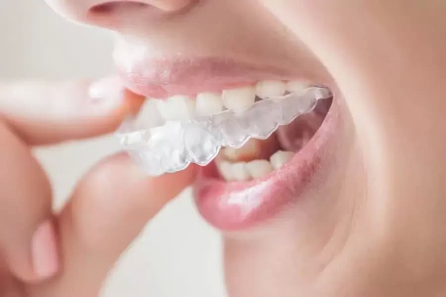 Den största skillnaden med att bleka tänderna hos tandläkaren och laga hål är att en tandblekning